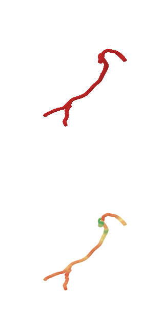 Refined prediction: red vessel surface above and radius-coloured surface below