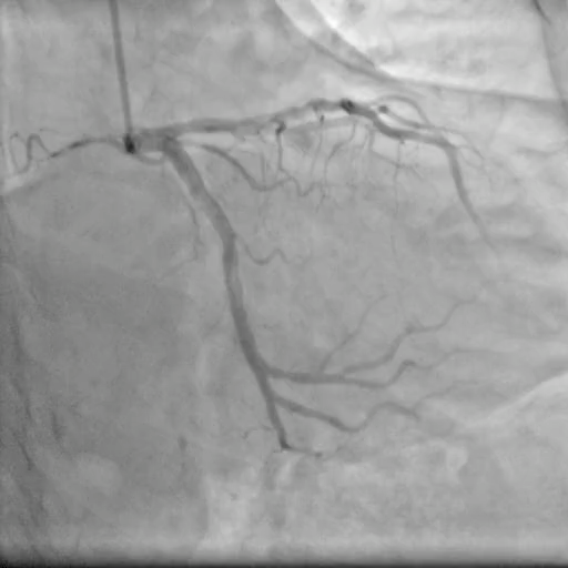 Selected X-ray angiography frame, view 1