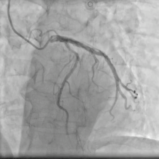 Selected X-ray angiography frame, view 2