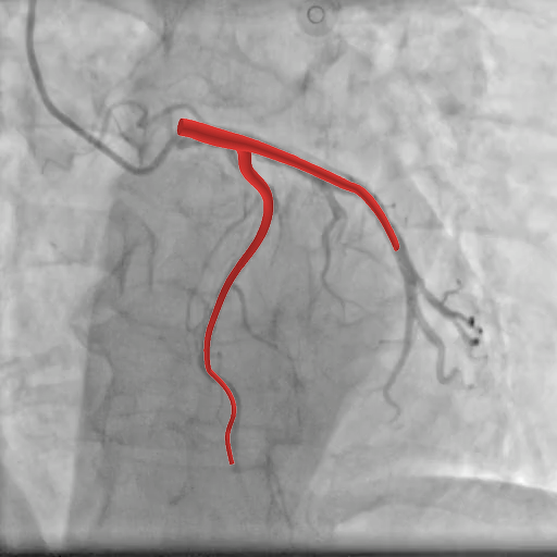 Prediction overlay on real X-ray view 2